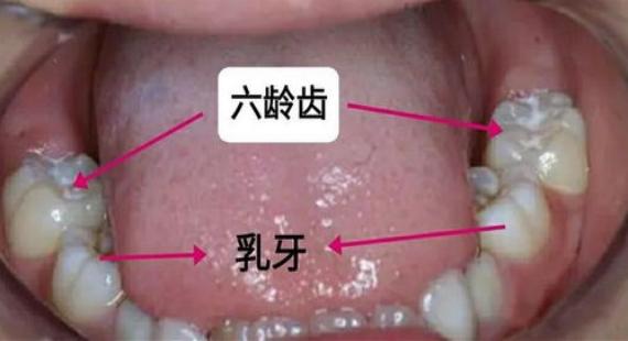 不同程度“六齡齒”齲齒的治療方法