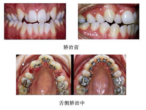舌側(cè)矯正后的口腔清潔方法