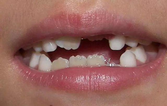 鑲牙對(duì)兒童恒牙生長(zhǎng)的影響