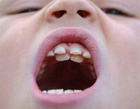 雙層牙的處理方法及預防措施