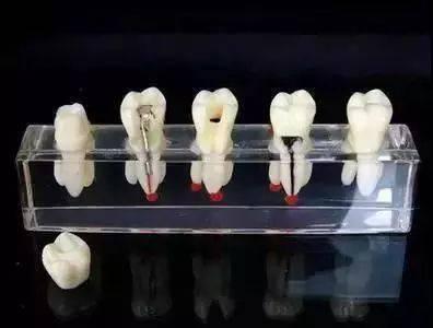 根管治療的具體過程