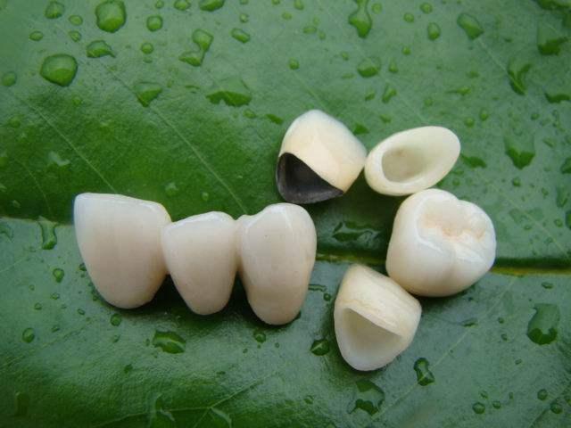 全瓷牙崩瓷修復(fù)過程中的注意事項(xiàng)