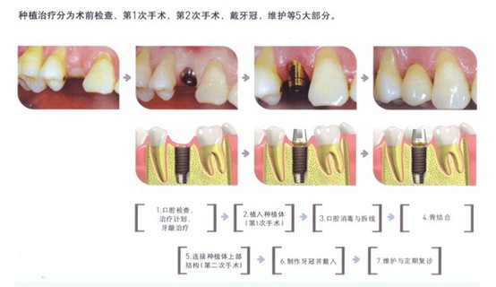種植牙過(guò)程