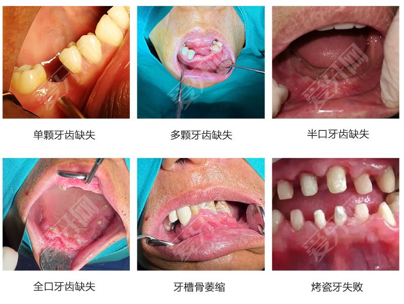 影響植牙價(jià)格的因素有哪些
