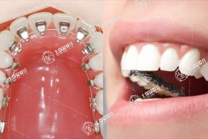 舌側(cè)矯正