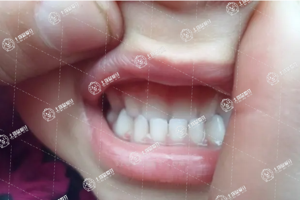 兒童牙齒