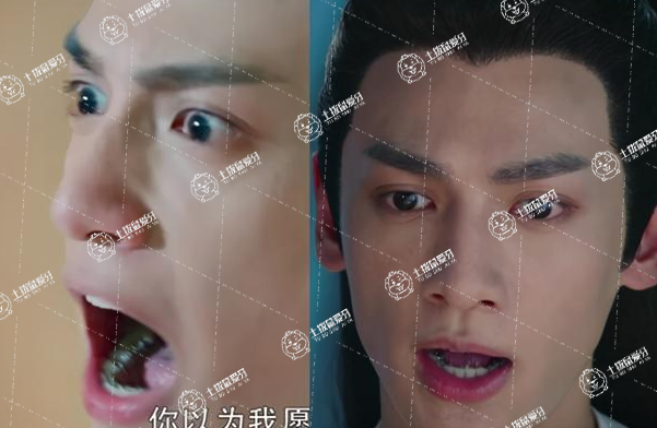 羅云熙舌側(cè)矯正