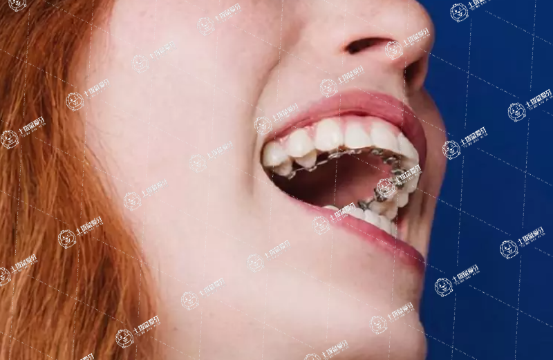 舌側(cè)矯正