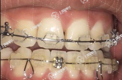 陶瓷矯正打骨釘