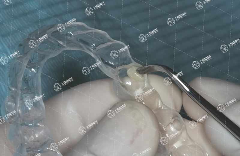 隱適美附件