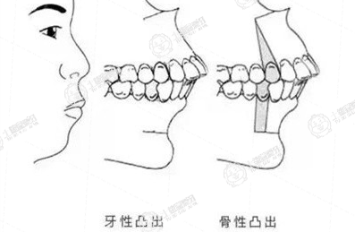 齙牙
