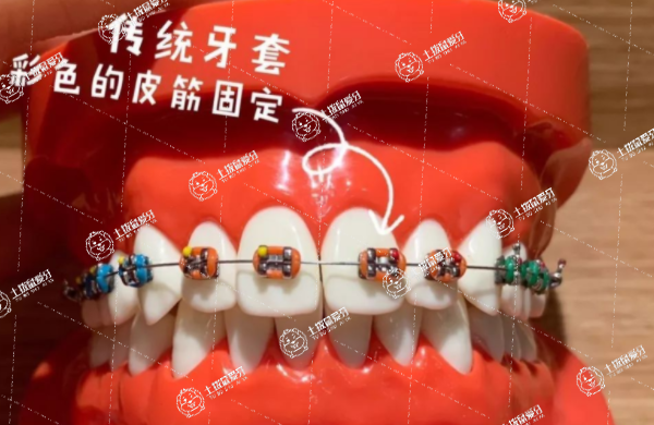 傳統(tǒng)金屬托槽