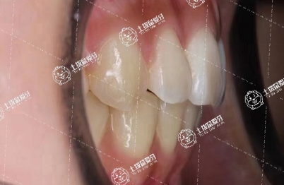 牙齒矯正后