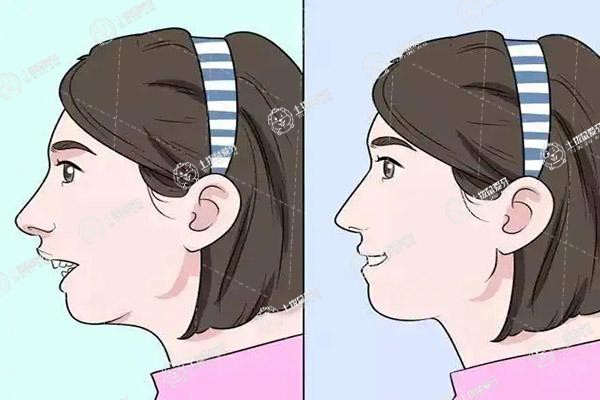 矯正牙齒需要拔牙嗎