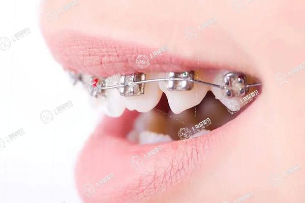 矯正牙齒會改變臉型嗎