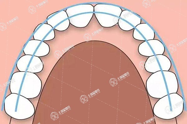 舌側(cè)矯正和傳統(tǒng)矯正哪個(gè)效果好
