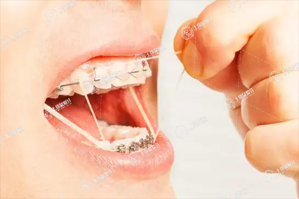 哪些人適合做舌側(cè)矯正
