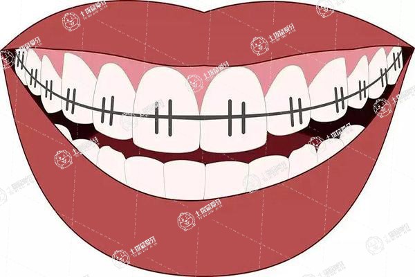 舌側(cè)矯正和傳統(tǒng)矯正哪個(gè)效果好