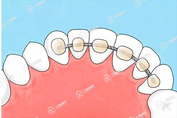 舌側(cè)隱形矯正器多少錢 舌側(cè)隱形矯正器什么樣