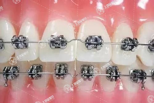 牙齒矯正完后會(huì)反彈嗎 反頜矯正后會(huì)反彈嗎