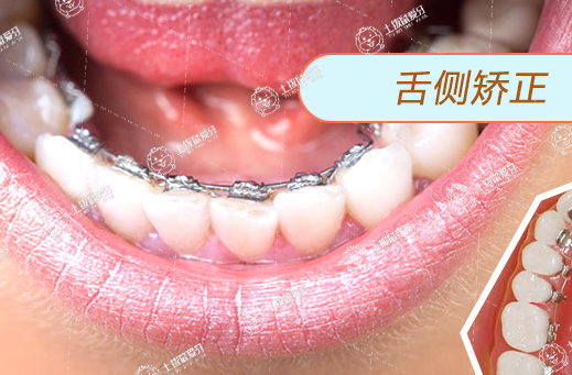 舌側矯正