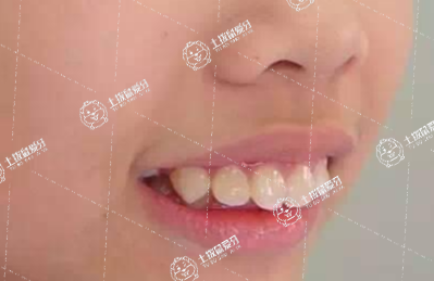 兒童牙齒外凸