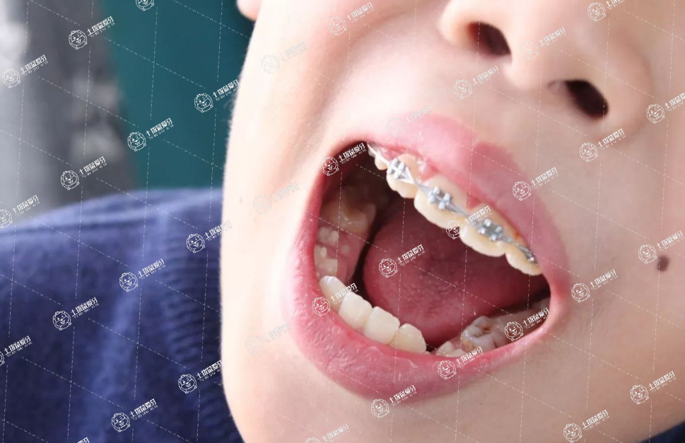 矯正牙齒戴牙套多少錢