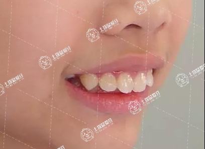 矯正門牙前突多少錢 