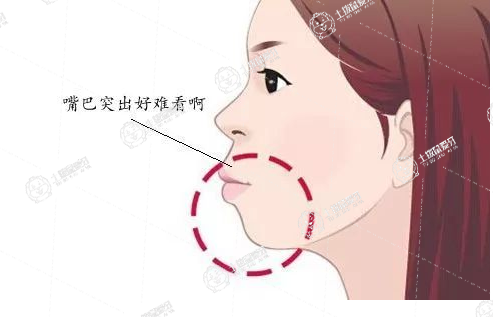 牙齒前突矯正多少錢(qián)