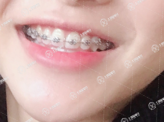 快速牙齒矯正多少錢