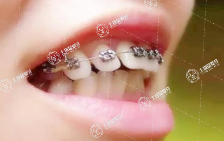 牙齒矯正反彈了怎么辦