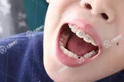 矯正牙齒的利與弊