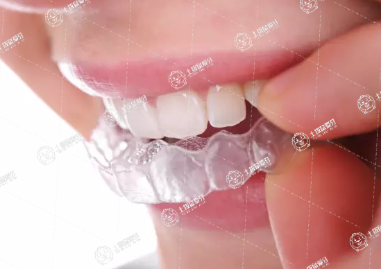 隱形矯正牙齒的過程痛嗎