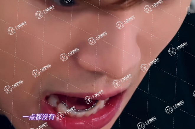 舌側(cè)矯正