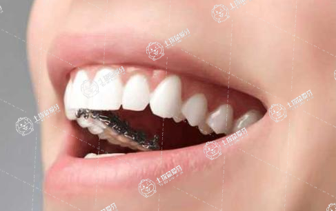 舌側(cè)矯正