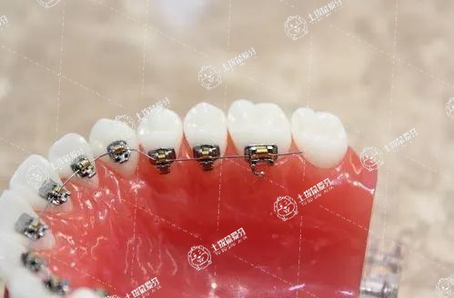 舌側(cè)隱形矯正效果怎么樣
