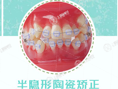 陶瓷牙套矯正器效果好嗎