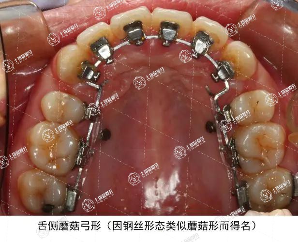 舌側(cè)隱形矯正效果怎么樣
