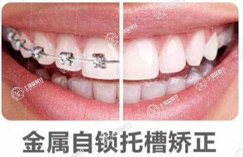 金屬自鎖托槽矯正