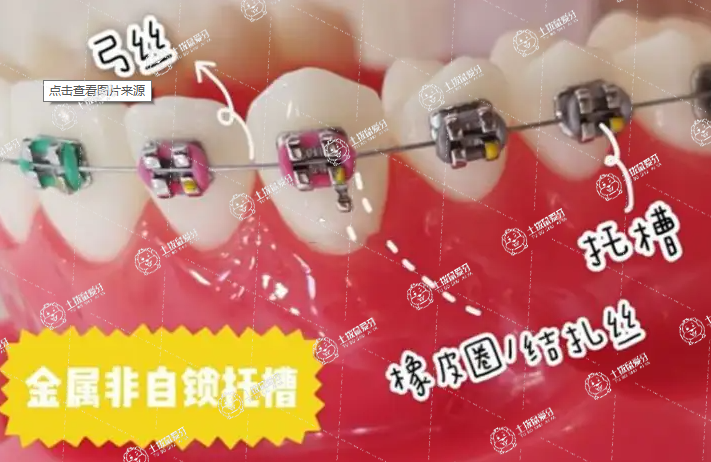 普通金屬托槽矯正