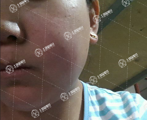 種植牙后臉腫了正常嗎