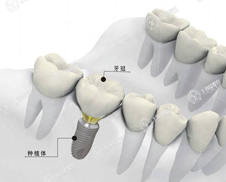 種植牙后牙齦發(fā)炎痛吃什么中成藥