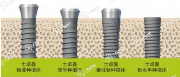 種植牙大概收費(fèi)