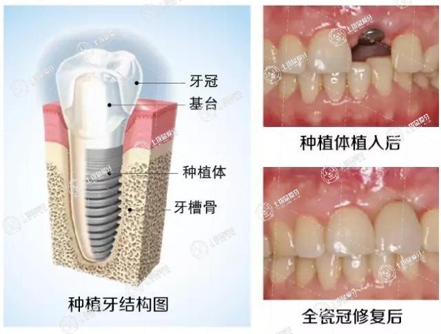 種植牙現(xiàn)在大概價(jià)格