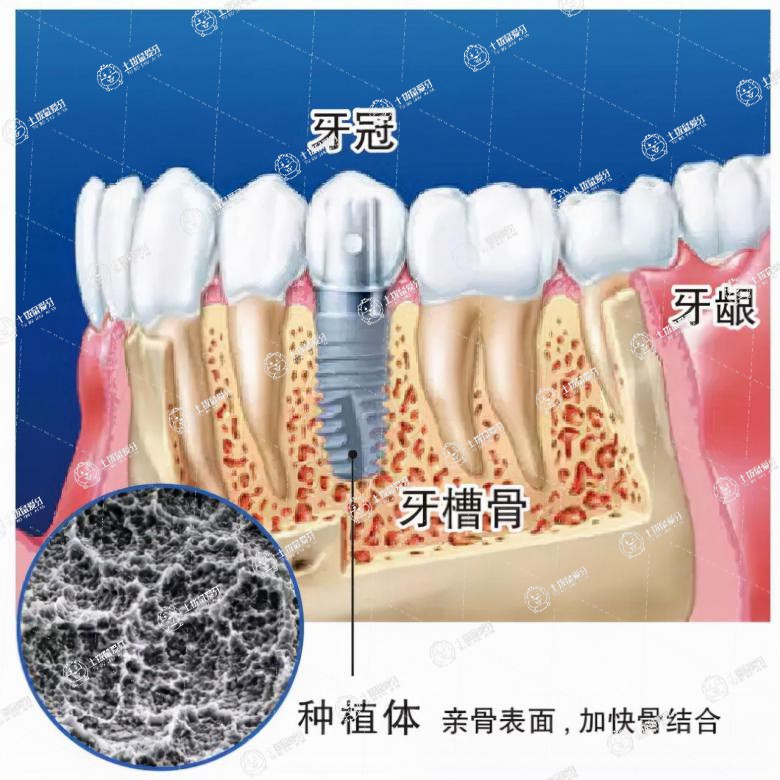 種植牙現(xiàn)在大概價(jià)格