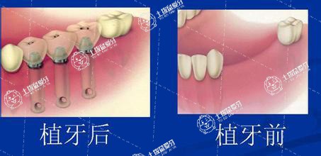 種植和假牙有什么區(qū)別