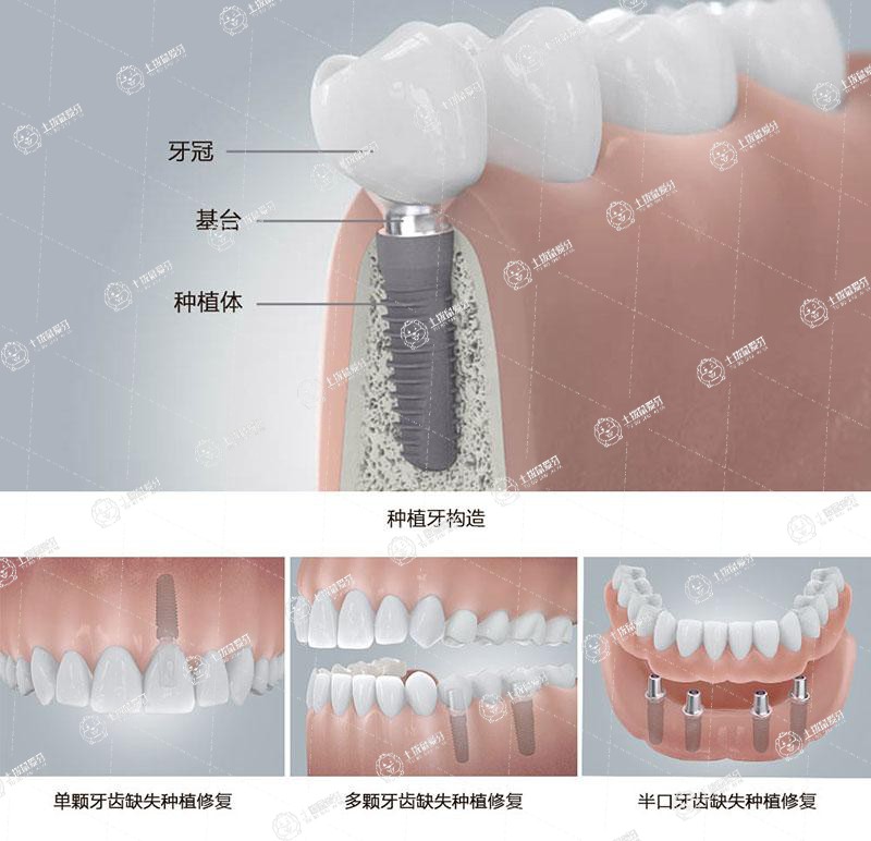 種植牙費(fèi)用怎么算