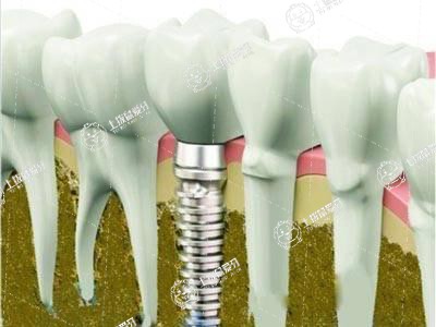 種植牙過后需要注意什么