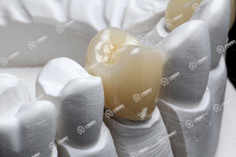鑲牙與種植牙的利弊