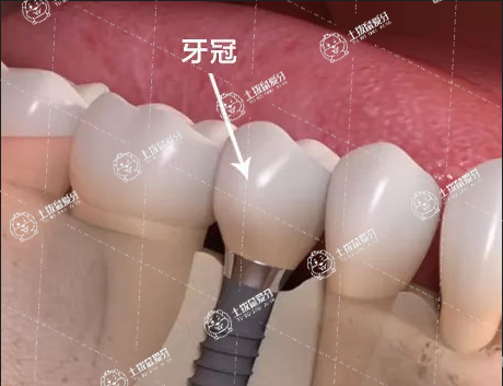 種植牙拆線前注意事項(xiàng)